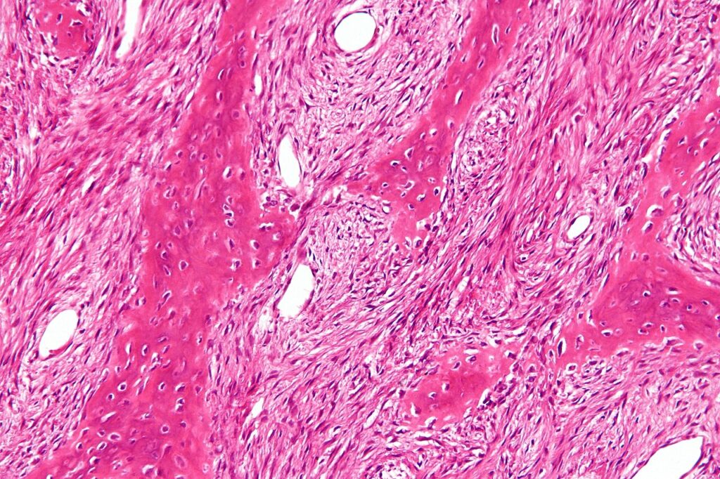 Histology of fibrous dysplasia showing woven bone trabeculae in a fibrous stroma