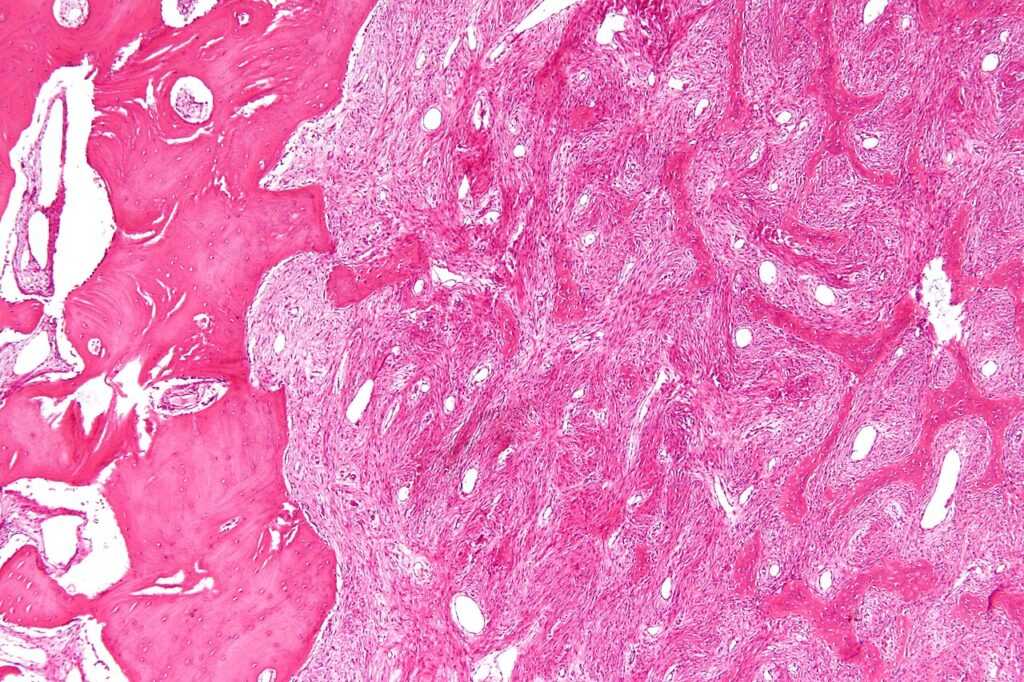 Histology of fibrous dysplasia, the bone lesion of McCune-Albright syndrome