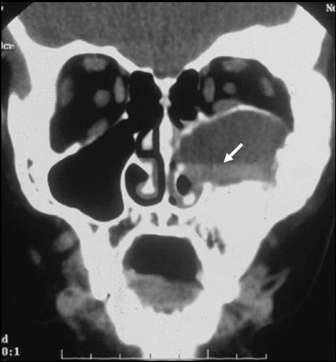 CT of craniofacial fibrous dysplasia in McCune-Albright syndrome
