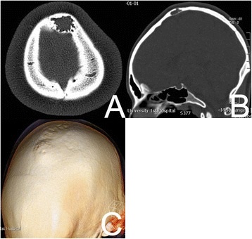 CT of a benign fibrous histiocytoma of the skull