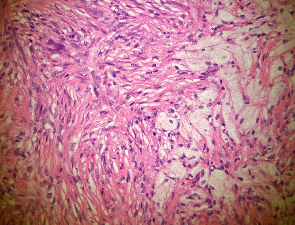 Histology of a non-ossifying fibroma showing a storiform spindle cell pattern