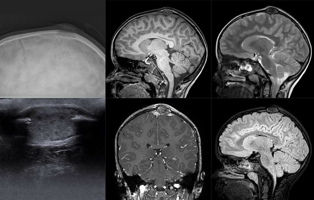 Radiograph, ultrasound and MRI of an eosinophilic granuloma of the skull vault in an infant