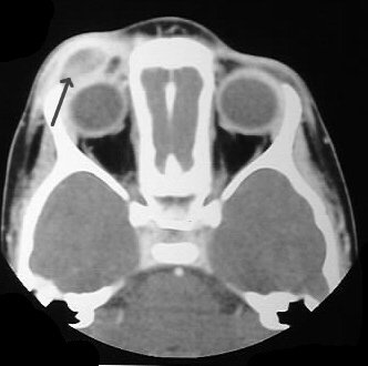 CT of periorbital Langerhans cell histiocytosis