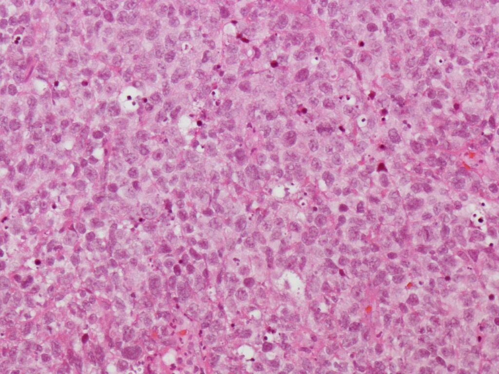 Histology of diffuse large B cell lymphoma (H and E)