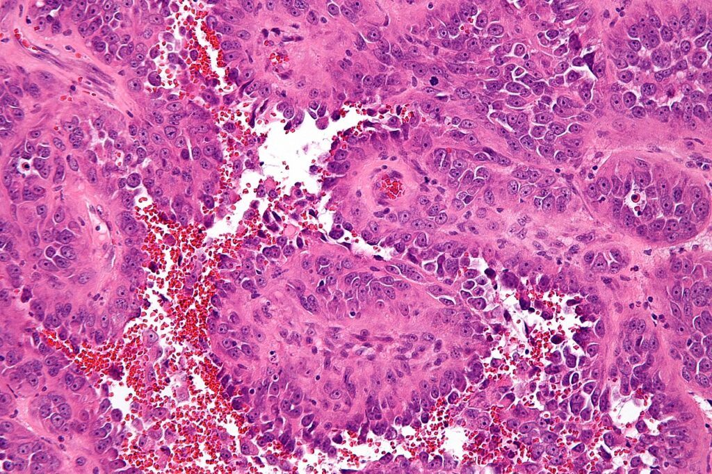 Histology of an epithelioid angiosarcoma