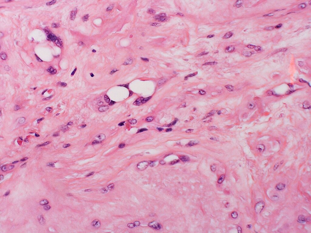 Histology of epithelioid haemangioendothelioma