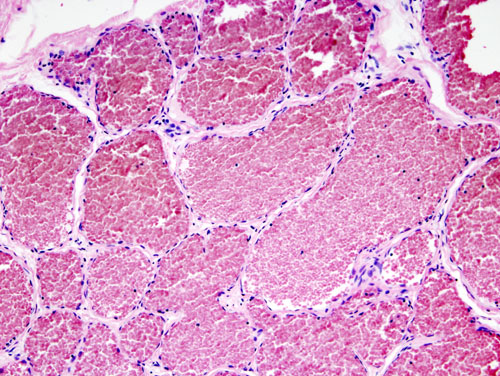 Histology of a cavernous haemangioma