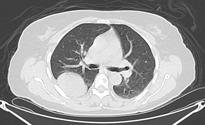 CT of a solitary fibrous tumour of the pleura