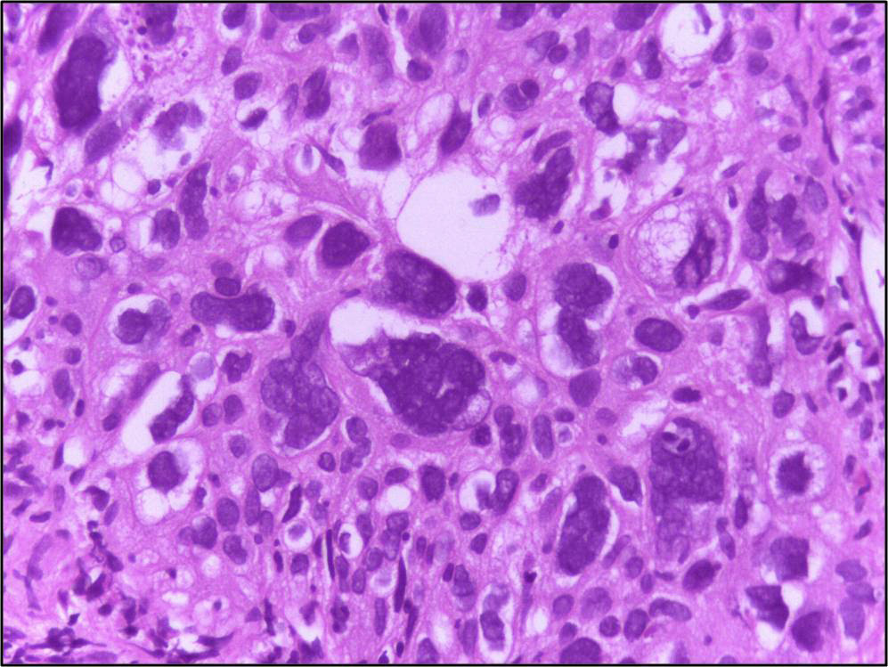 Histology of a high grade malignant tumour with bizarre tumour giant cells