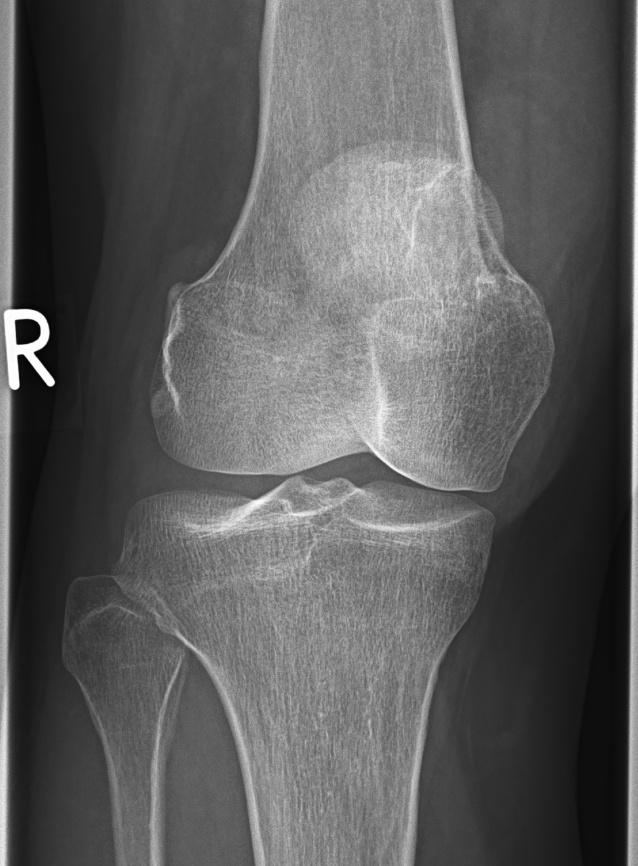 AP radiograph of a giant cell tumour of bone