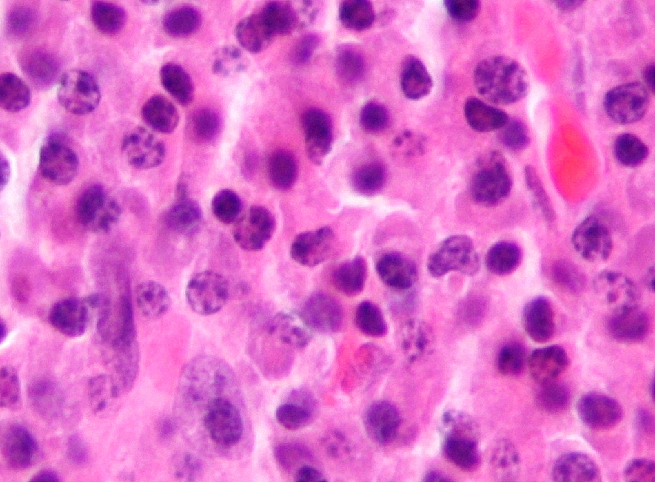 Histology of a plasmacytoma showing sheets of plasma cells (H and E)