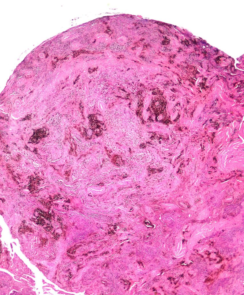 Histology of pigmented villonodular synovitis