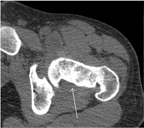 CT of pigmented villonodular synovitis of the hip