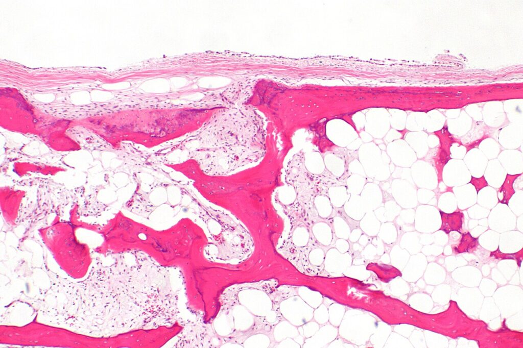 Histology of a loose body in synovial chondromatosis
