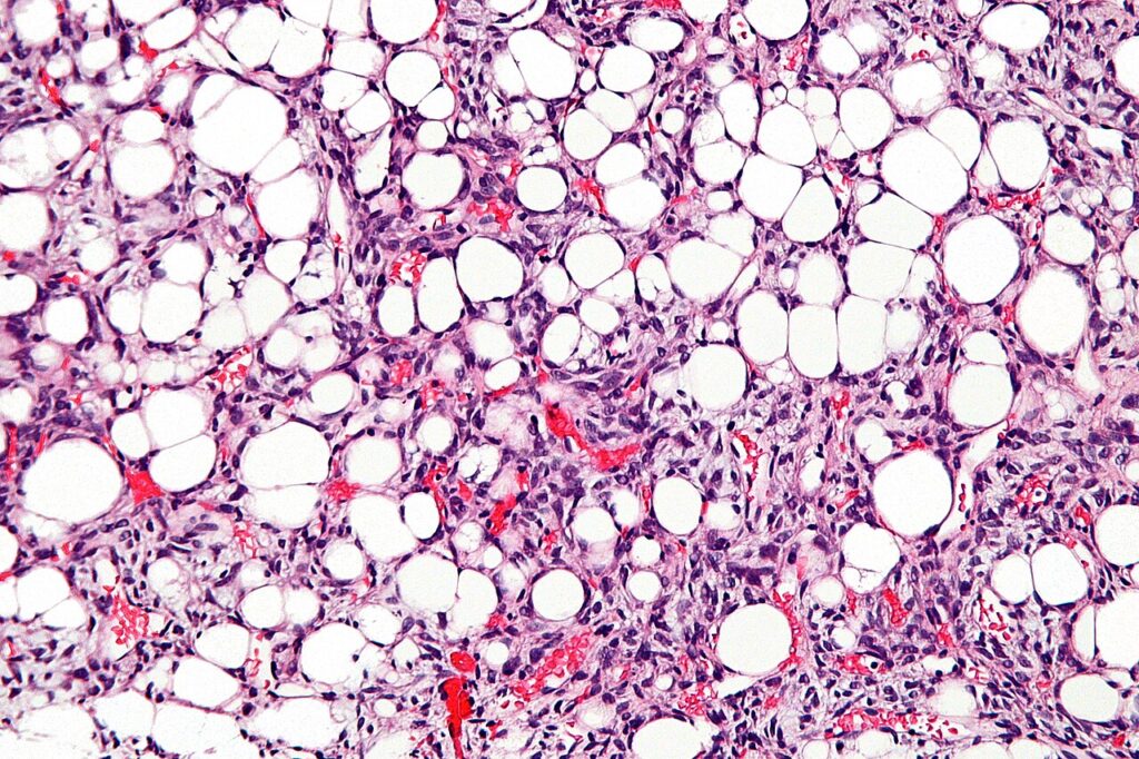 Histology of a liposarcoma