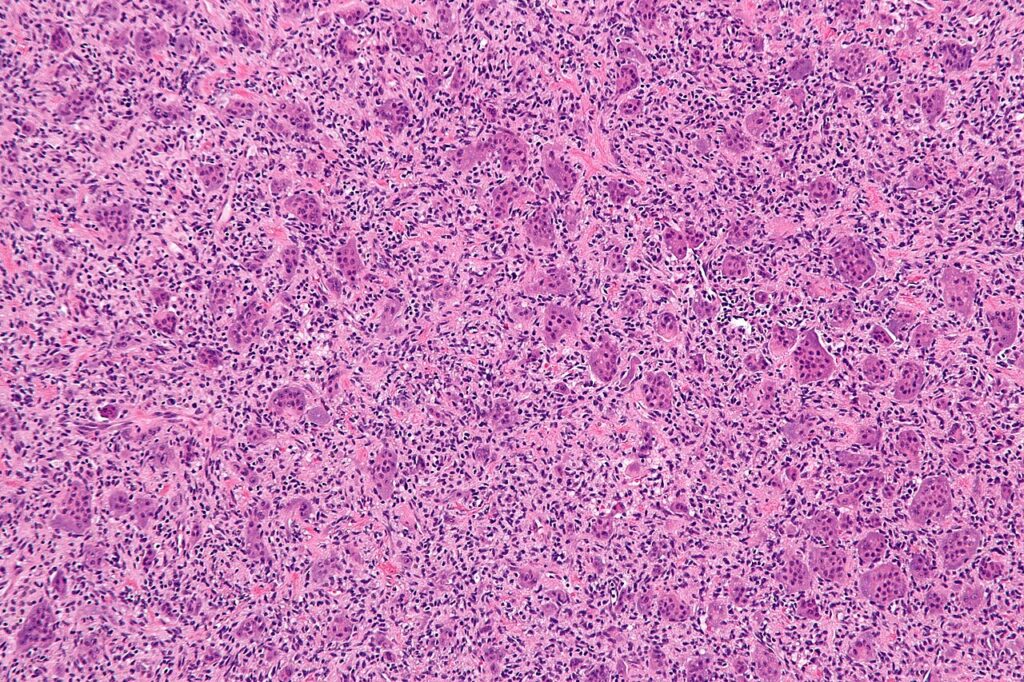 Tumour iSAWE 3, biopsy histology (h and e)