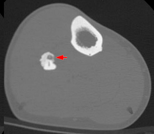 Tumour iSAWE 4, axial ct of the leg