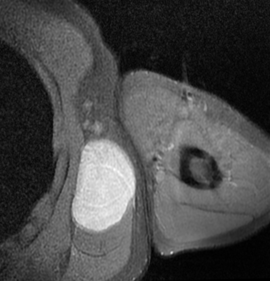 Tumour iSAWE 5, axial mri