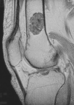 Tumour iSAWE 7, sagittal t1 mri of the distal femur