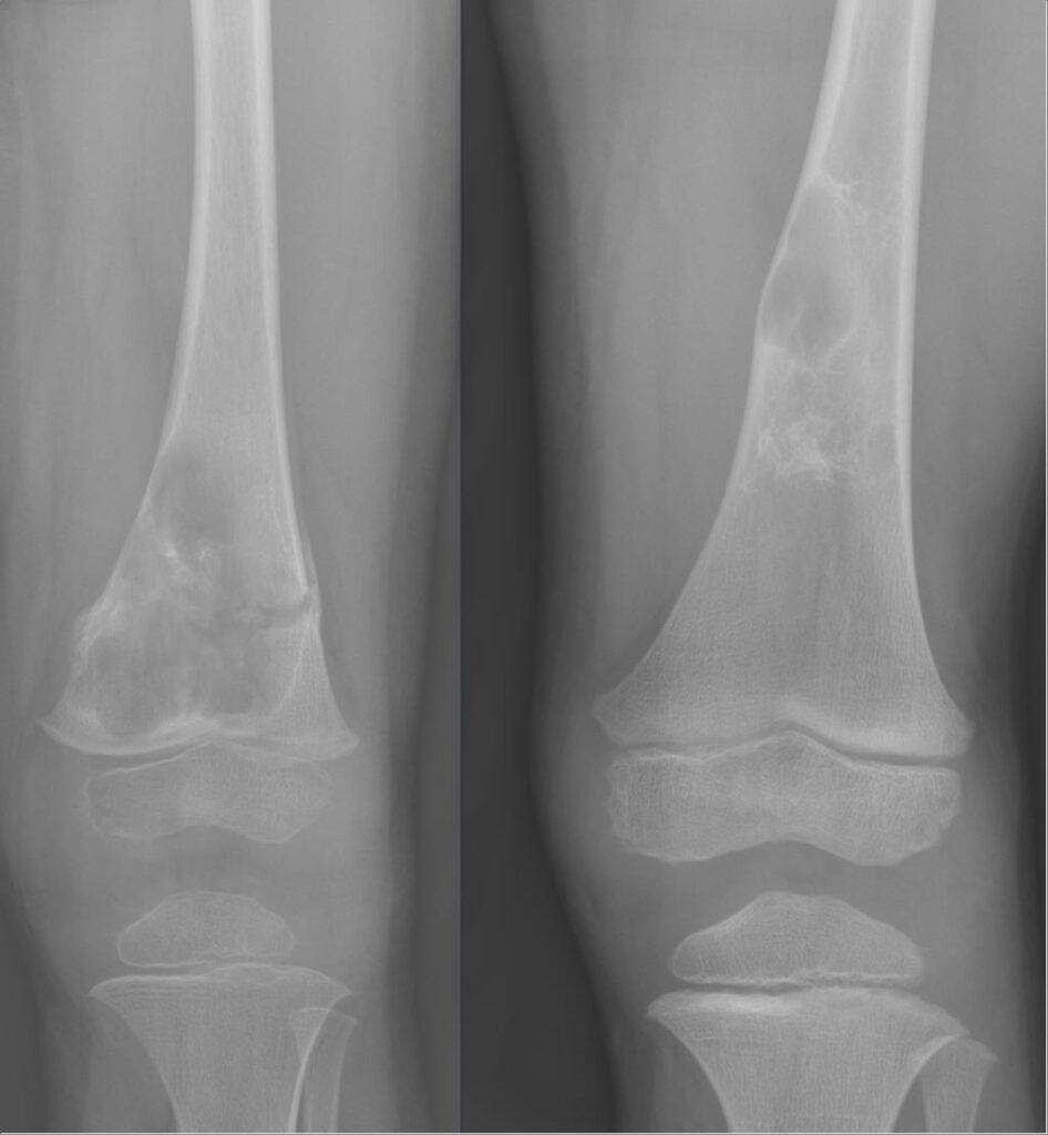 Tumour iSAWE 8, serial radiographs of the femur