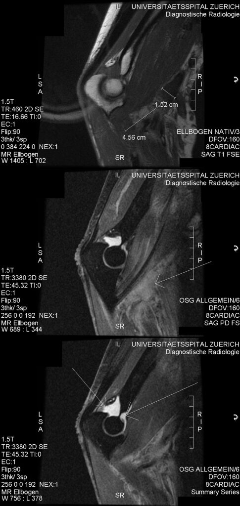 Two-incision Boyd-Anderson Distal Biceps Tendon Repair, mri showing rupture of the distal biceps tendon