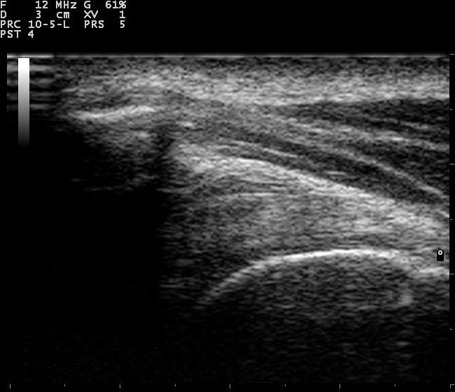 Ultrasound, ultrasound of the shoulder