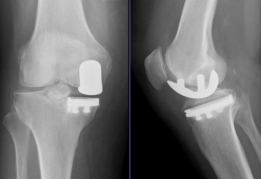 Arthroplasty iSAWE 8, AP and lateral radiographs of the knee