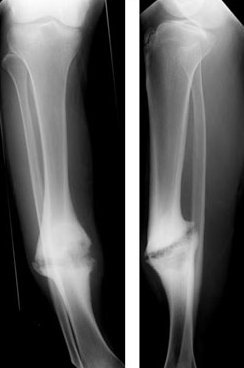 Union / Non-union, radiograph of a fracture nonunion