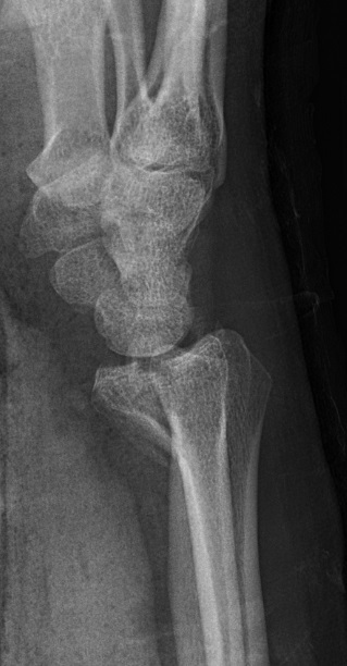 Hand iSAWE 17, lateral radiograph of the wrist
