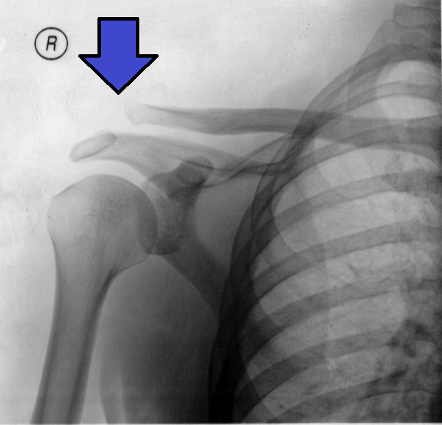 Weaver-Dunn Procedure, radiograph of an acromioclavicular joint separation