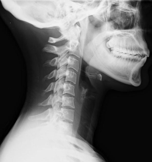Whiplash Injury, lateral radiograph of the cervical spine after a whiplash injury