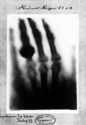 X-rays, the first medical radiograph, taken by wilhelm röntgen in 1895 of his wife’s hand