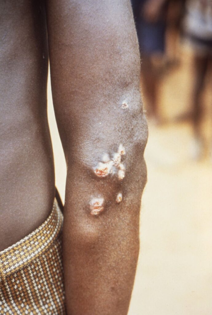 Yaws, skin lesion of yaws